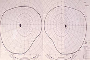 Gesichtsfelduntersuchung – Augenärztliche Gemeinschaftspraxis | Dr. Heuring, Dr. Jung & Kollegen