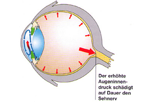 Grüner Star – Augenärztliche Gemeinschaftspraxis | Dr. Heuring, Dr. Jung & Kollegen